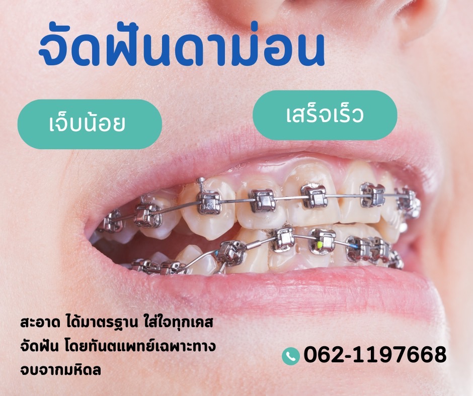 จัดฟันดาม่อน